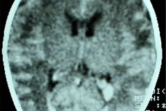 hemorragia-intraventricular-tac-1994-003