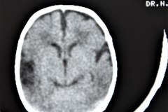 hemorragia-intraventricular-y-leucoencefalomalacia-tac-rn1m-1991-000