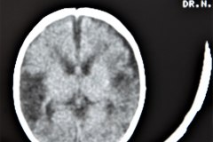 hemorragia-intraventricular-y-leucoencefalomalacia-tac-rn1m-1991-001