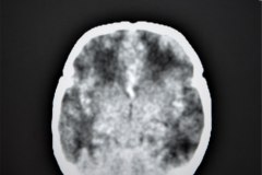 hemorragia-intraventricular-y-leucoencefalomalacia-tac-rn1m-1991-002
