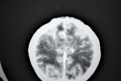 hemorragia-intraventricular-y-leucoencefalomalacia-tac-rn1m-1991-005