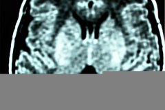 hemorragia-peri-e-intra-ventricular-rnm-2000-000
