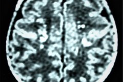 hemorragia-peri-e-intra-ventricular-rnm-2000-001