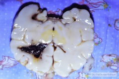 hemorragia-subaracnoidea-intraventricular-y-dilatacion-ventricular-1996-001
