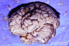 hemorragia-subaracnoidea-intraventricular-y-dilatacion-ventricular-1996-008