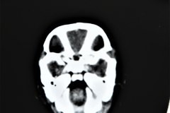 hemorragia-subaracnoidea-tac-1993-001