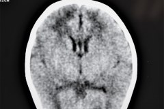 hemorragia-subaracnoidea-tac-rnm-1998-010