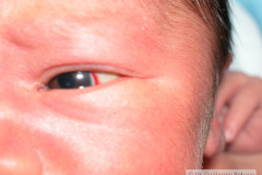 hemorragia-subconjuntival-2009-001