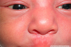 hemorragia-subconjuntival-2009-002