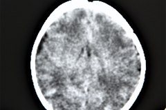 hemorragia-subdural-tac-1992-000