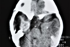 hemorragia-subdural-tac-1992-001