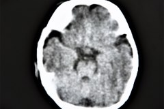 hemorragia-subdural-tac-1992-002