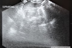 hemorragia-suprarrenal-hematoma-quiste-2000-001