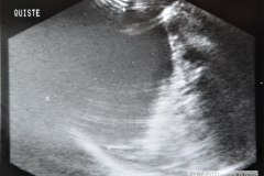 hemorragia-suprarrenal-hematoma-quiste-2000-003