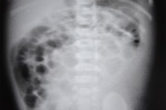 hemorragia-suprarrenal-hematoma-quiste-2000-004