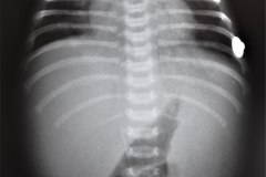 hepato-esplenomegalia-1998-001