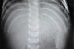 hepato-esplenomegalia-1998-003