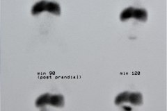 hepatomegalia-gamagrafia-1994-002