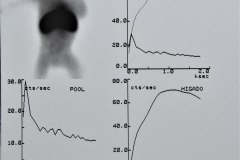 hepatomegalia-gamagrafia-1994-003