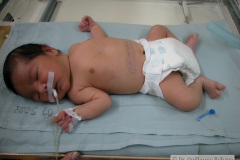 herida-quirurgica-atresia-intestinal-2004-000