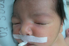 herida-quirurgica-atresia-intestinal-2004-002