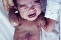herida-quirurgica-ileostomia-1989-000