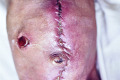 herida-quirurgica-ileostomia-1989-003