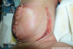 heridas-de-relajacion-para-cierre-onfalocele-2005-000