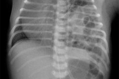 hernia-diafragmatica-congenita-hdc-bochdalek-amplia-izq-2009-000