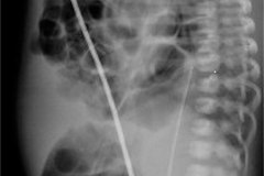 hernia-diafragmatica-congenita-hdc-bochdalek-amplia-izq-2009-001