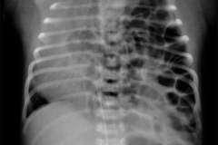 hernia-diafragmatica-congenita-hdc-bochdalek-amplia-izq-2009-002