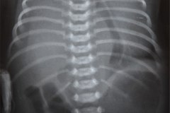 hernia-diafragmatica-congenita-hdc-bochdalek-lateral-der-herniacion-hepatica-neumotorax-neumoperitoneo-desviacion-mediastino-1989-002