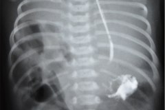 hernia-diafragmatica-congenita-hdc-bochdalek-lateral-der-herniacion-hepatica-neumotorax-neumoperitoneo-desviacion-mediastino-1989-006