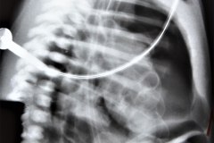 hernia-diafragmatica-congenita-hdc-bochdalek-lateral-der-postop-1996-001