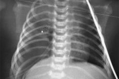hernia-diafragmatica-congenita-hdc-bochdalek-lateral-der-postop-1996-002