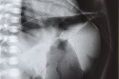 hernia-diafragmatica-congenita-hdc-bochdalek-lateral-izq-neumotorax-neumoperitoneo-1997-000