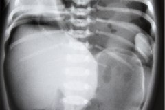 hernia-diafragmatica-congenita-hdc-bochdalek-lateral-izq-neumotorax-neumoperitoneo-1997-001