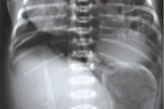 hernia-diafragmatica-congenita-hdc-bochdalek-lateral-izq-neumotorax-neumoperitoneo-1997-002