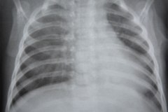 hernia-diafragmatica-congenita-hdc-bochdalek-lateral-izq-postop-1986-001