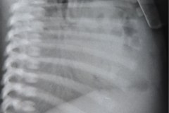 hernia-diafragmatica-congenita-hdc-bochdalek-lateral-izq-postop-1986-003