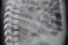 hernia-diafragmatica-congenita-hdc-bochdalek-lateral-izq-postop-1986-008