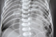 hernia-diafragmatica-congenita-hdc-bochdalek-lateral-izq-raquisquisis-hemivertebra-1997-001