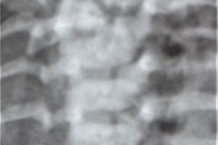 hernia-diafragmatica-congenita-hdc-bochdalek-lateral-izq-raquisquisis-hemivertebra-1997-003