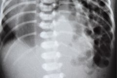 hernia-diafragmatica-congenita-hdc-bochdalek-lateral-izq-raquisquisis-hemivertebra-1997-004