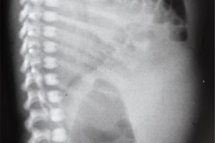 hernia-diafragmatica-congenita-hdc-bochdalek-latero-posterior-izq-2002-000