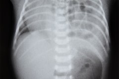hernia-diafragmatica-congenita-hdc-bochdalek-latero-posterior-izq-2002-001