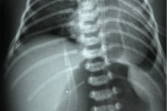 hernia-diafragmatica-congenita-hdc-bochdalek-latero-posterior-izq-distension-gastrica-intubacion-esofagica-postop-1997-001