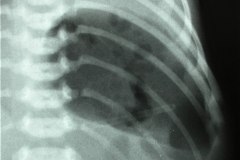 hernia-diafragmatica-congenita-hdc-bochdalek-latero-posterior-izq-distension-gastrica-intubacion-esofagica-postop-1997-002