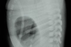 hernia-diafragmatica-congenita-hdc-bochdalek-latero-posterior-izq-distension-gastrica-intubacion-esofagica-postop-1997-003