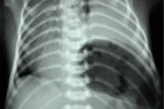 hernia-diafragmatica-congenita-hdc-bochdalek-latero-posterior-izq-distension-gastrica-intubacion-esofagica-postop-1997-004